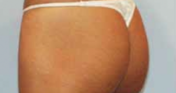 Implants glutéaux
