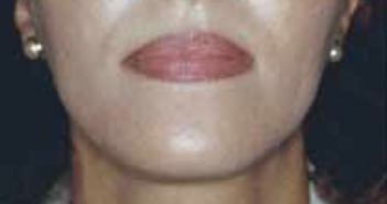 Micro-injections de graisse au niveau du visage