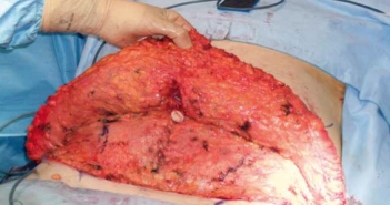 Abdominoplastie sans drainage et capitonnage par surjets de fils crantés : à propos de 36 cas