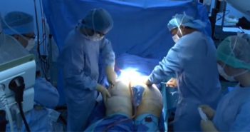 Film : Le Bodylift inférieur : technique chirurgicale