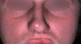Rhinoplastie des fentes unilatérales labio‑maxillo‑palatines