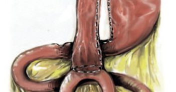 Principes de la prise en charge chirurgicale de l’obésité massive chez l’adulte