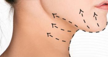 Lifting cervical et corset digastrique
