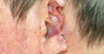 Quoi de neuf en chirurgie dermatologique ?