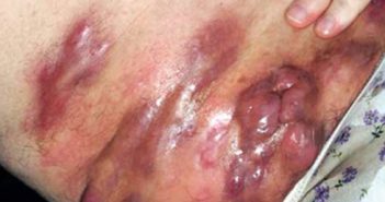Maladie de Verneuil : aspects cliniques