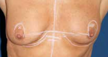 Traitement chirurgical de la pseudo-ptose en augmentation mammaire