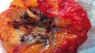 Nodule d’endométriose sur cicatrice d’abdominoplastie : à propos d’un rare cas et revue de la littérature