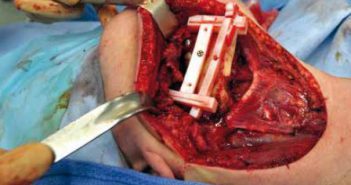 Apport de la conception assistée par informatique et de l’impression 3D pour la reconstruction mandibulaire par lambeau ostéocutané de fibula après cancer