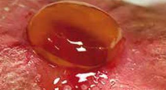 Le plasma riche en plaquettes en chirurgie plastique