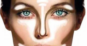 Le contouring quand il n’y a pas de défaut dominant