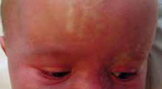 Actualités dans les tumeurs et malformations vasculaires
