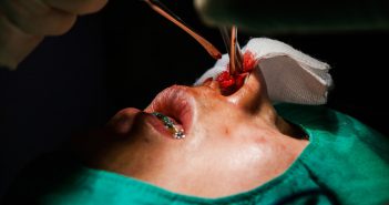 Quel traitement pour le rhinophyma ?
