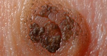 Dermatofibrosarcome de Darier-Ferrand