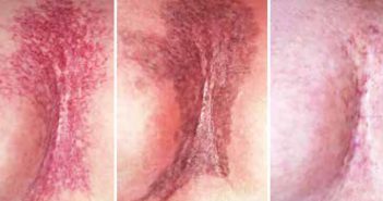 Traitement des radiodermites chroniques après un cancer du sein par les lasers vasculaires