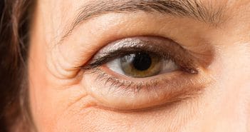 Blépharoplastie inférieure étendue primaire : maximiser le résultat esthétique tout en minimisant les complications