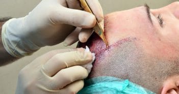 10 étapes pour débuter une activité de greffe capillaire