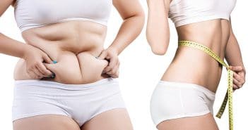 Cryoliposuccion du ventre : nouvelle procédure de liposuccion, description technique