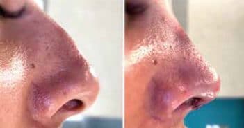 La preservation rhinoplasty ou rhinoplastie 3.0
