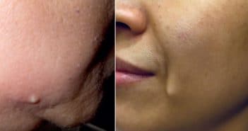 Fils faciaux : complications et comment les éviter
