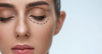 Réinterventions et insuffisances des blépharoplasties esthétiques : comment les éviter ?