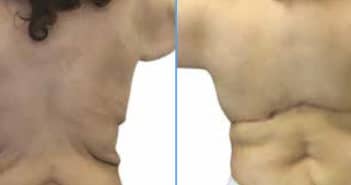 La thoracoplastie latérale comme alternative au bodylift supérieur pour le traitement de l’excès cutané dorsal après amaigrissement massif