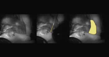 Angiographie au vert d’indocyanine : résultats préliminaires de la surveillance des lambeaux en microchirurgie