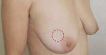 Oncoplastie dans le cadre du traitement chirurgical conservateur des cancers du sein