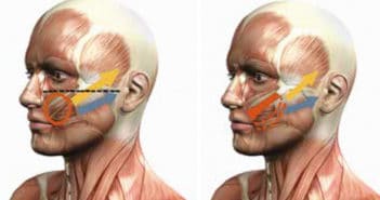 High SMAS facelift : toujours plus haut
