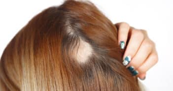 Alopécie féminine, enfin une solution ! Hairstetics, une avancée scientifique et technologique
